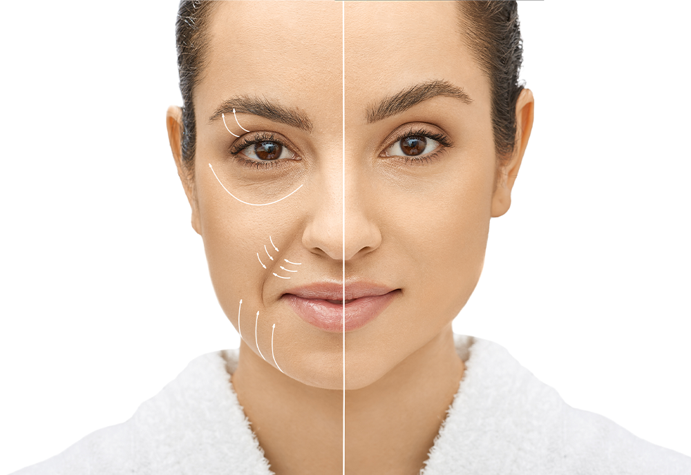 Photo of a woman with a line separating the two halves of her face. One is saggier and has lines indicating treatment areas. The other half shows a tight, smooth face.