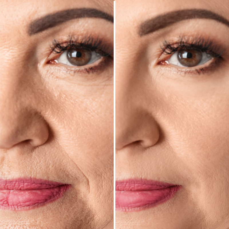 Side by side photo of a woman's face. Her skin is smoother on the right than the left.