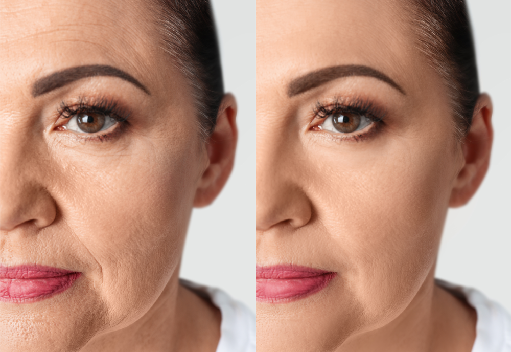 Side by side photo of a woman's face. Her skin is smoother on the right than the left.