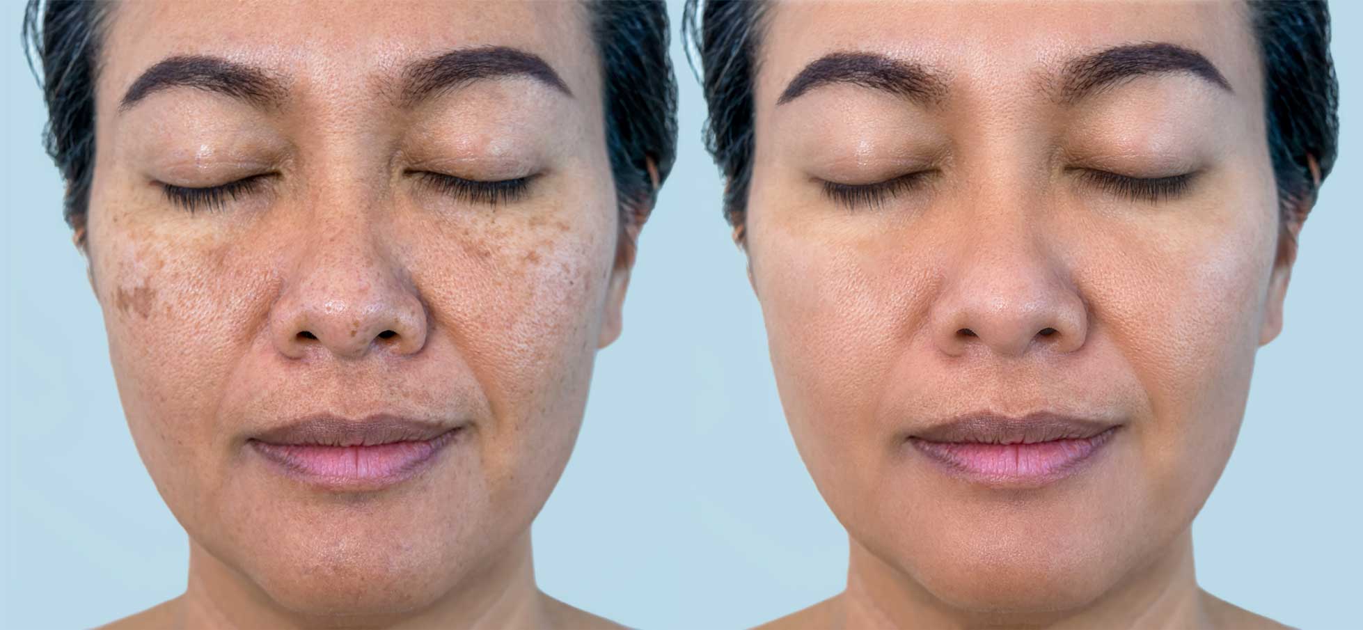 Photo of a woman before and after treatment. Before she has dark melanin freckles. After, they are clear.